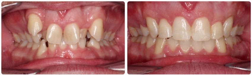 Before and After Cook Orthodontics Augusta ME