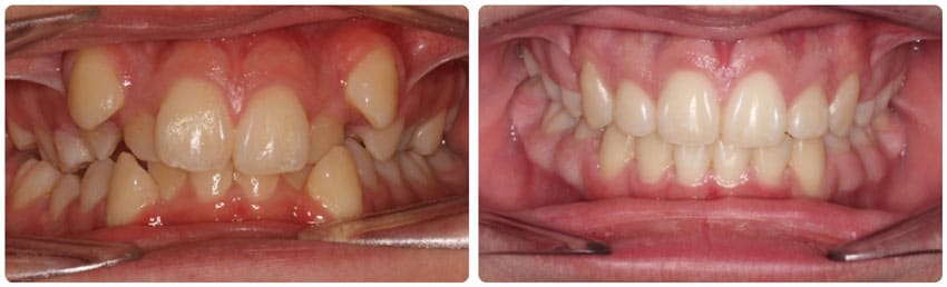 Before and After 2 Cook Orthodontics Augusta ME