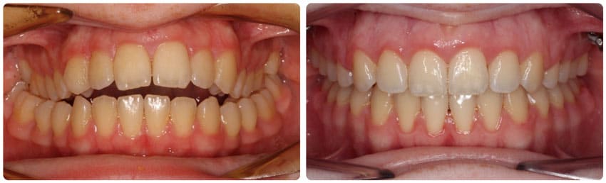 Before and After 3 Cook Orthodontics Augusta ME