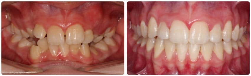 Before and After 4 Cook Orthodontics Augusta ME