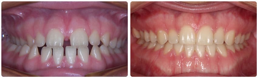 Before and After 5 Cook Orthodontics Augusta ME