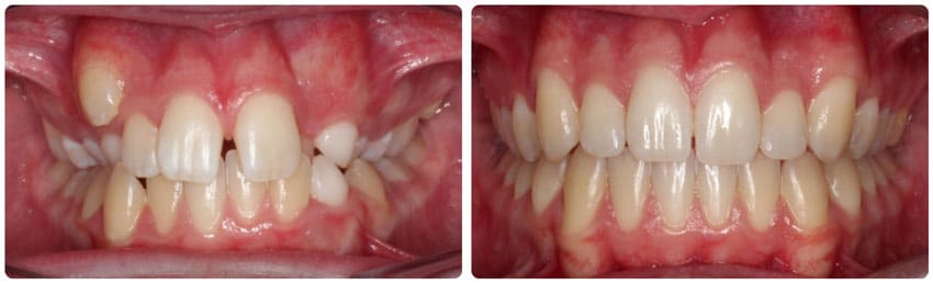 Before and After 6 Cook Orthodontics Augusta ME