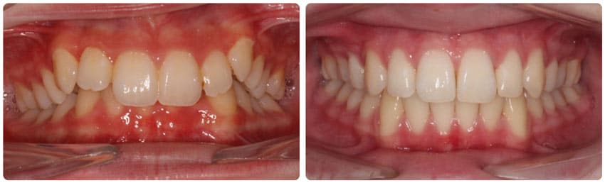 Before and After 7 Cook Orthodontics Augusta ME