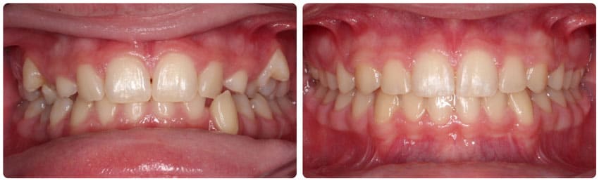 Before and After 8 Cook Orthodontics Augusta ME