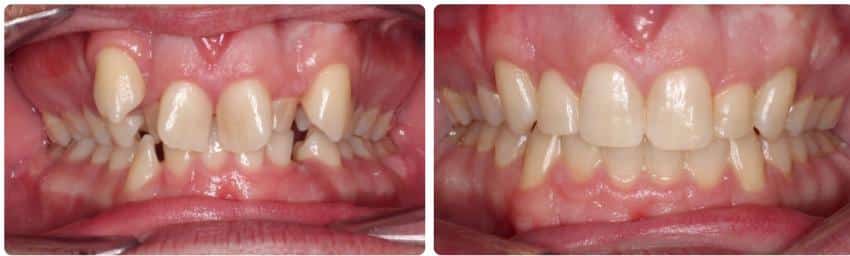 Before and after Cook Orthodontics in Augusta, ME