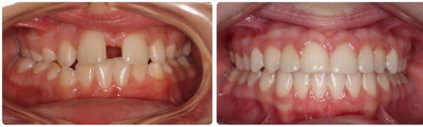 Before and after Cook Orthodontics in Augusta, ME