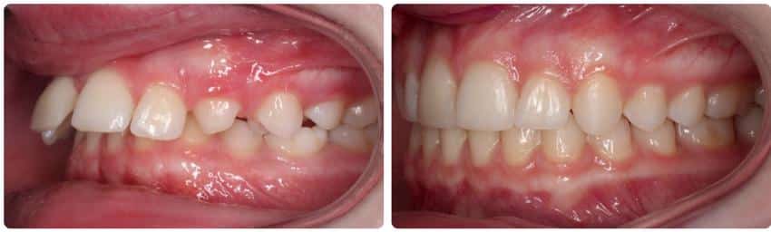 Before and after Cook Orthodontics in Augusta, ME